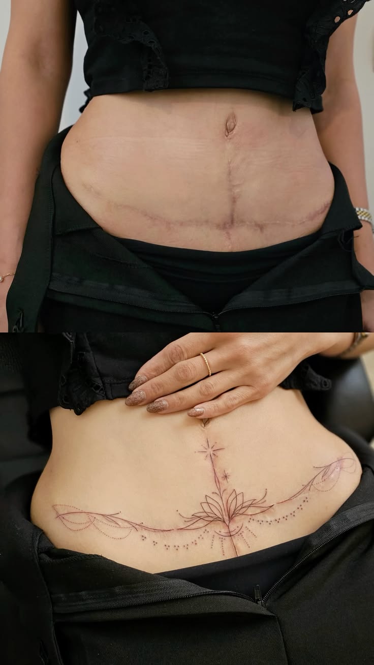 C-section scar camouflage before and after results for a client from Wapda Town Lahore