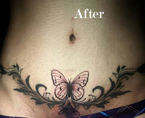 After photo of belly scar covered with a butterfly and floral tattoo
