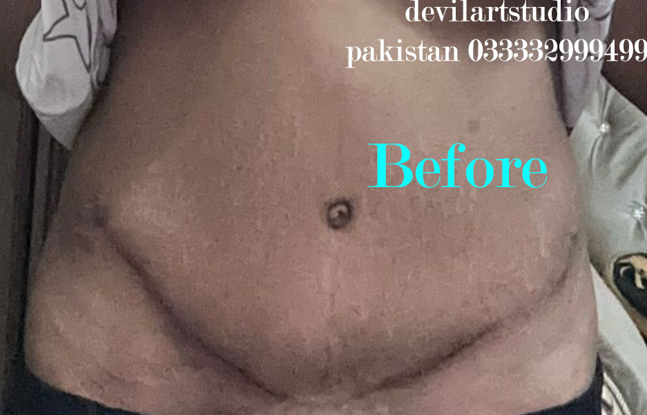 Before photo of belly scar prior to cover-up tattoo