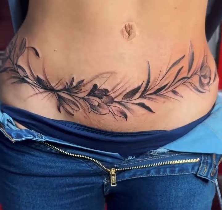 Stretch mark camouflage tattoo result on abdomen in Lahore